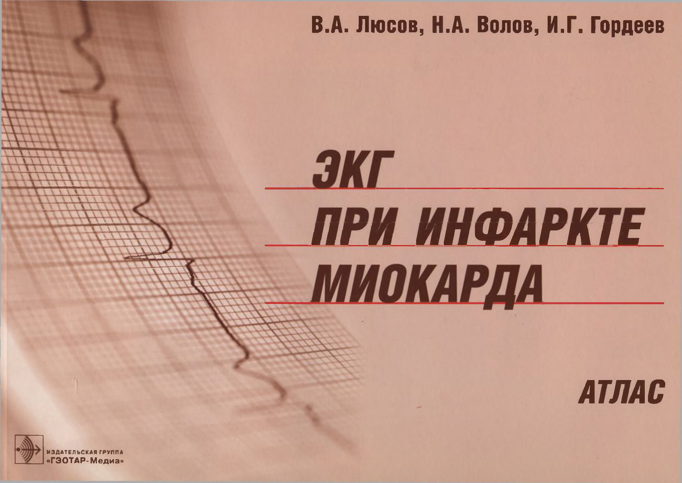 ЭКГ ПРИ ИНФАРКТА МИОКАРДА