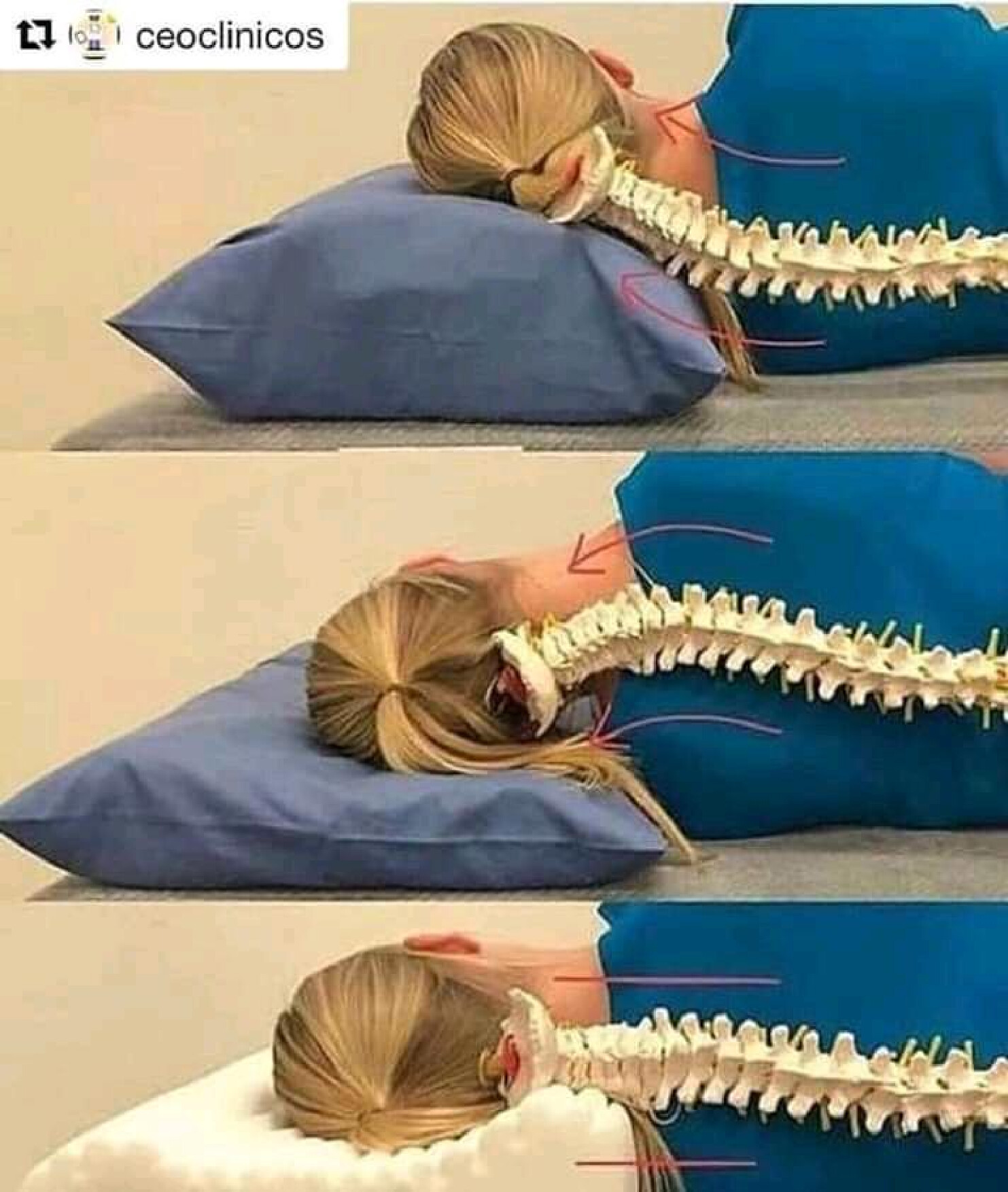 SPINE ET AL