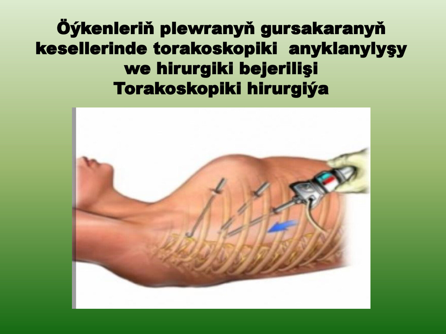 TORAKOSKOPIKI HIRURGIÝA