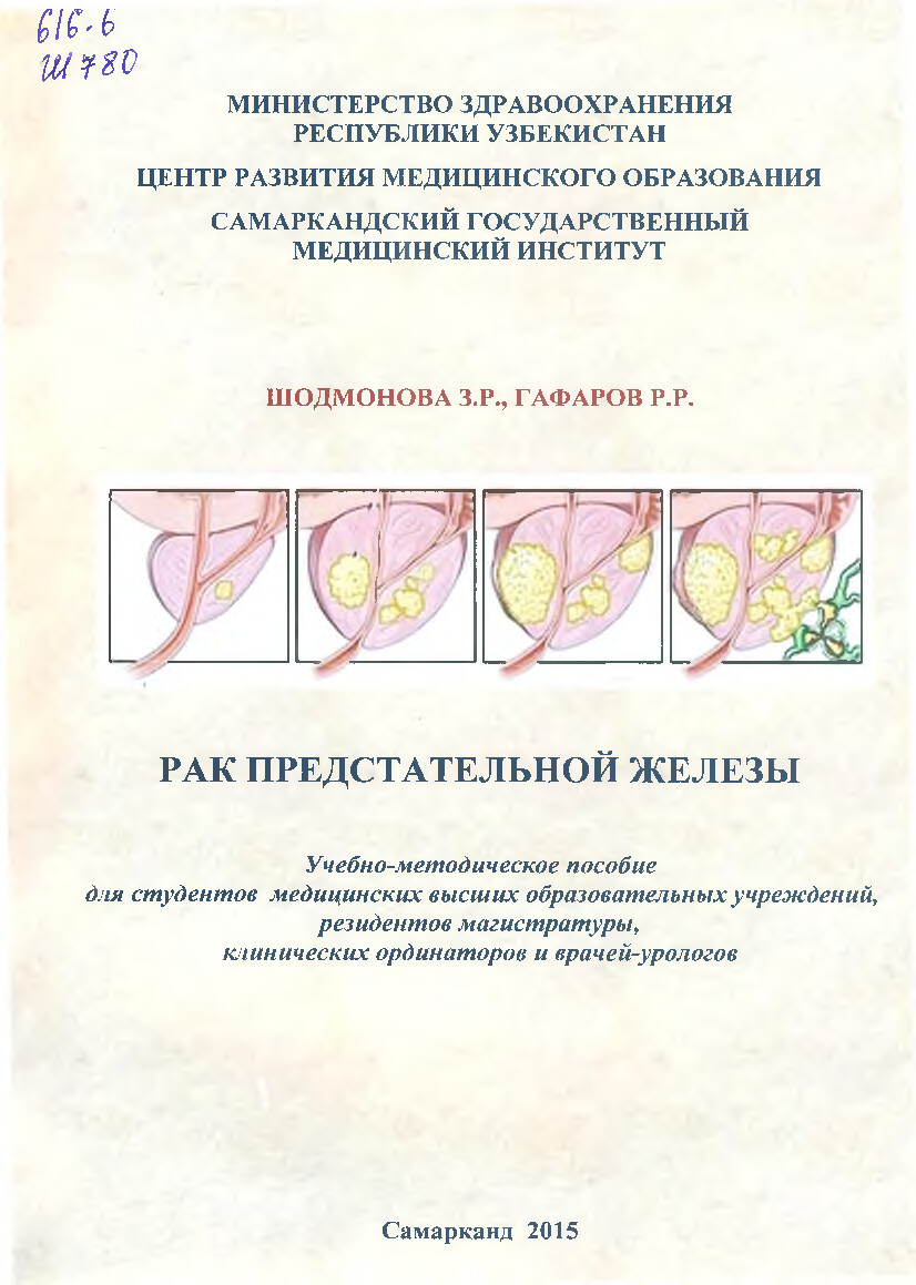 РАК ПРЕДСТАТЕЛЬНОЙ ЖЕЛЕЗЫ