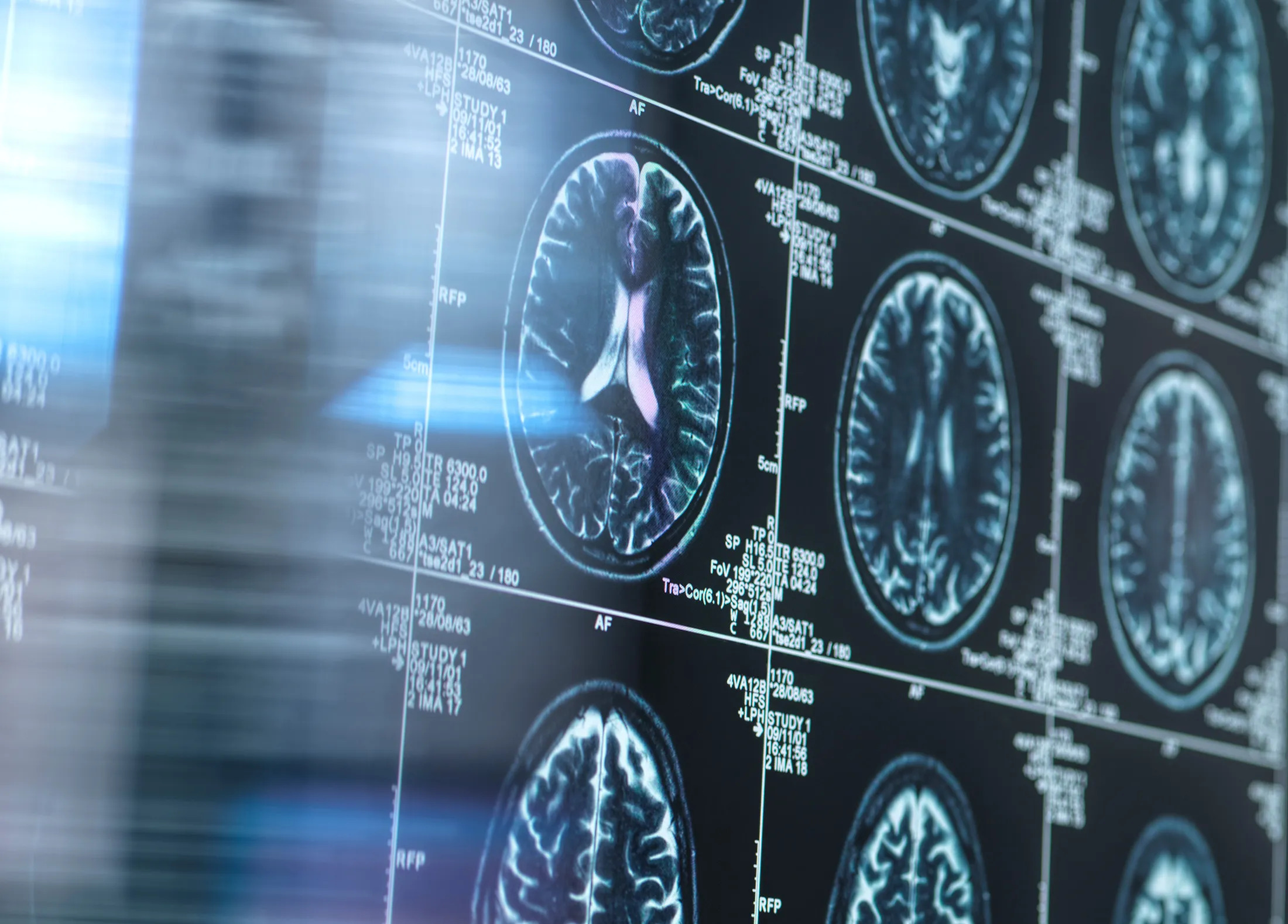 Şweýsariýada Alsgeýmer keseline garşy dermanyň kliniki synaglary başlaýar