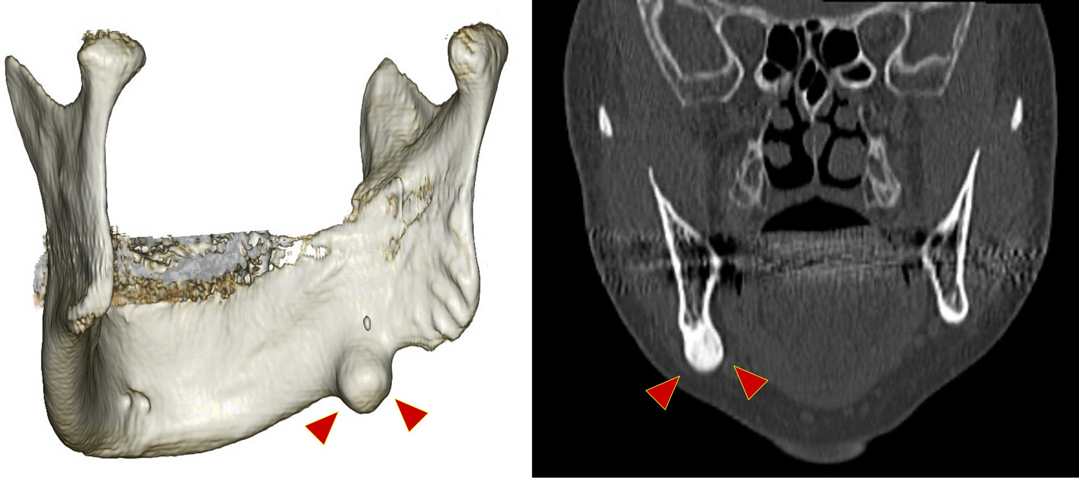 Osteoblastoma