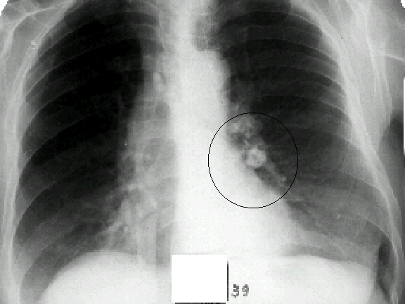 Gursakiçki limfatiki düwünleriniň inçekeseli