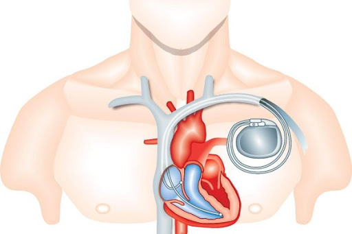 Elektrokardiostimulýasiýa