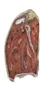 Öýkenleriň tuberkulýomasy