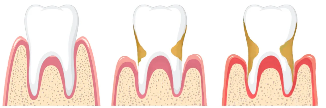 1-tip süýji diabetli 7 ýaşly çagalarda