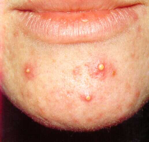 IMMUNE SYSTEM