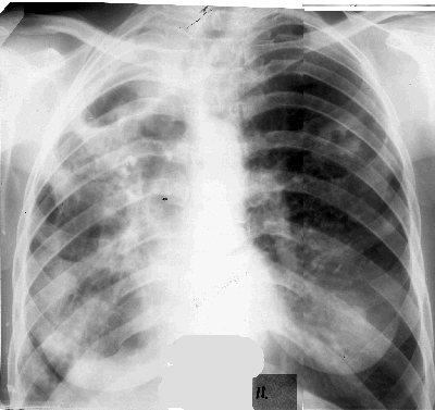 Destruktiw inçekesel görnüşleri. sirrotiki inçekesel
