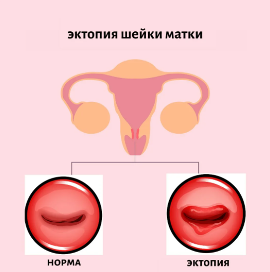 Hakyky we ýalan eroziýalar