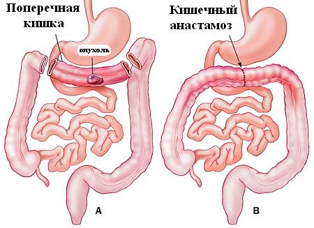 ЖЕЛУДОЧНО КИШЕЧНОМ КРОВОТЕЧЕНИИ (ЖКК)