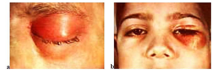 Gabaklaryň keselleri