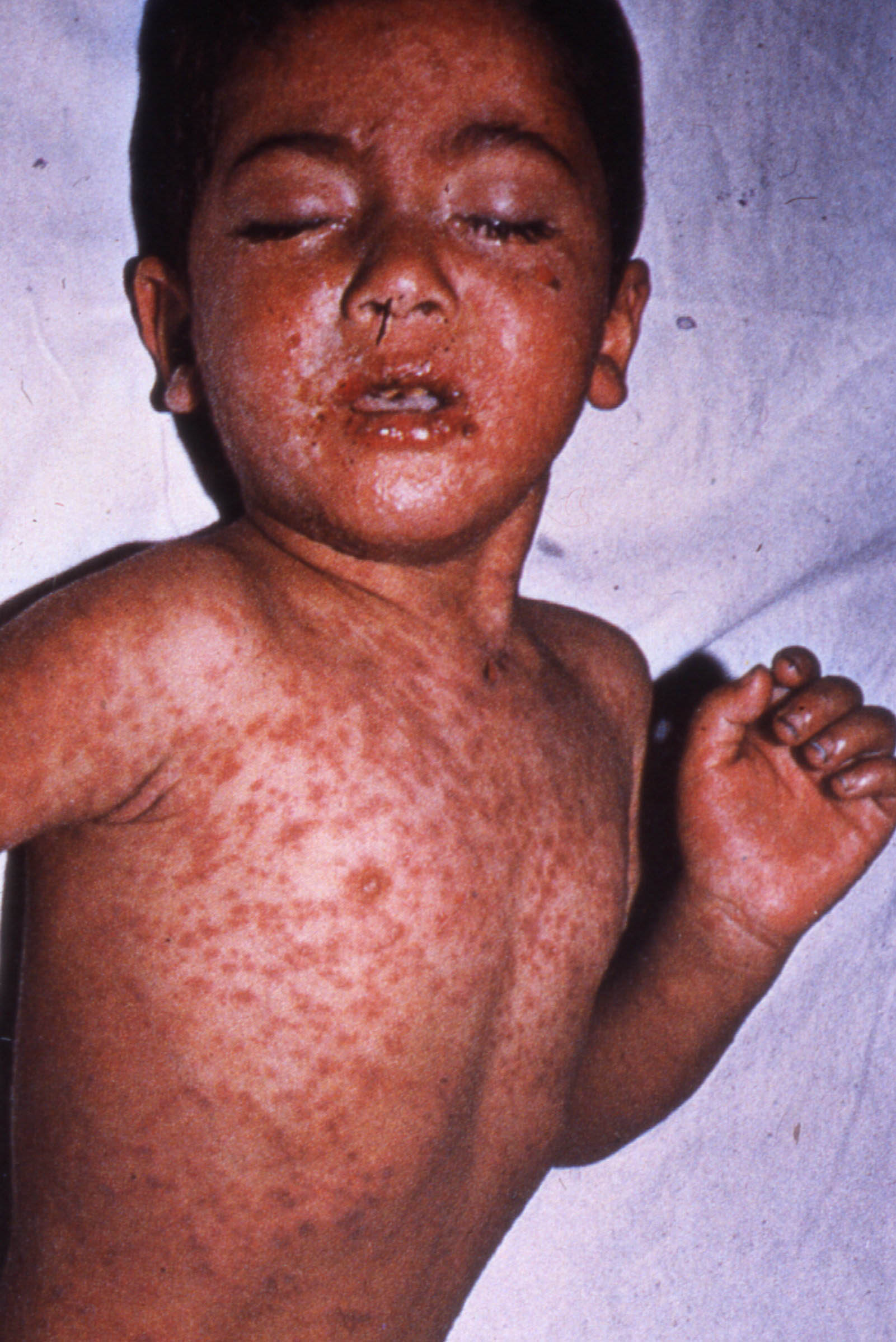 VIRUS MEASLES