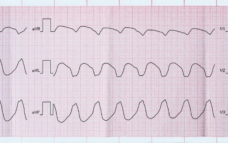 Ýürek geçirijiliginiň we ritminiň ýönekeý bozulmalary. holter monitorirleme gözegçiligi