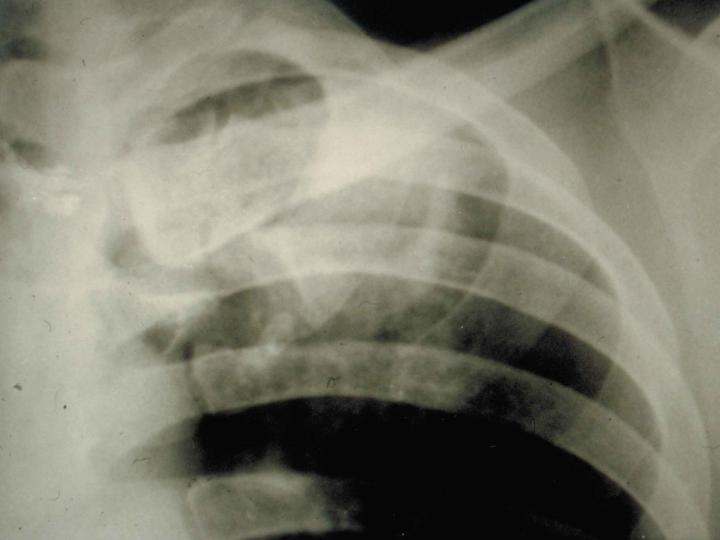 Incekeseliň etiologiýasy we patogenezi